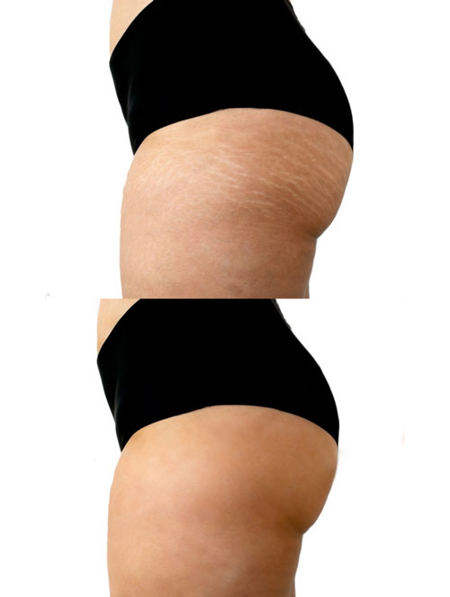 Koreanmed-stretch-marks-removal-treatment