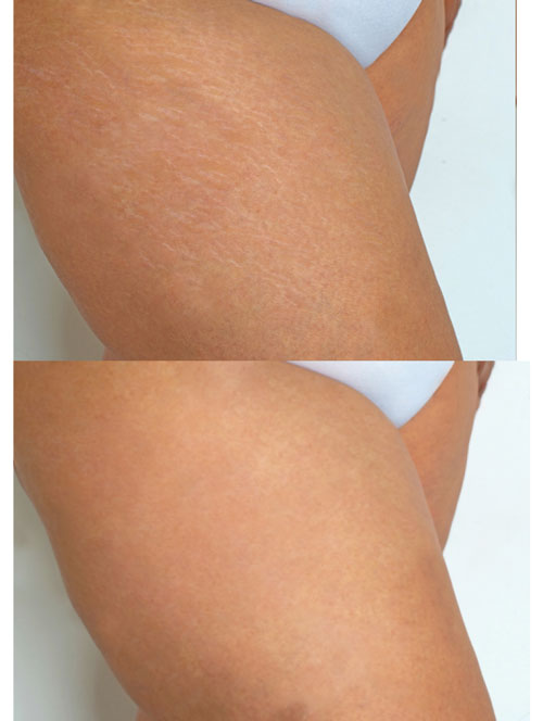 Koreanmed-stretch-marks-removal-treatment4
