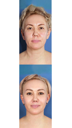 Smas_lifting_koreanmed_almaty_3