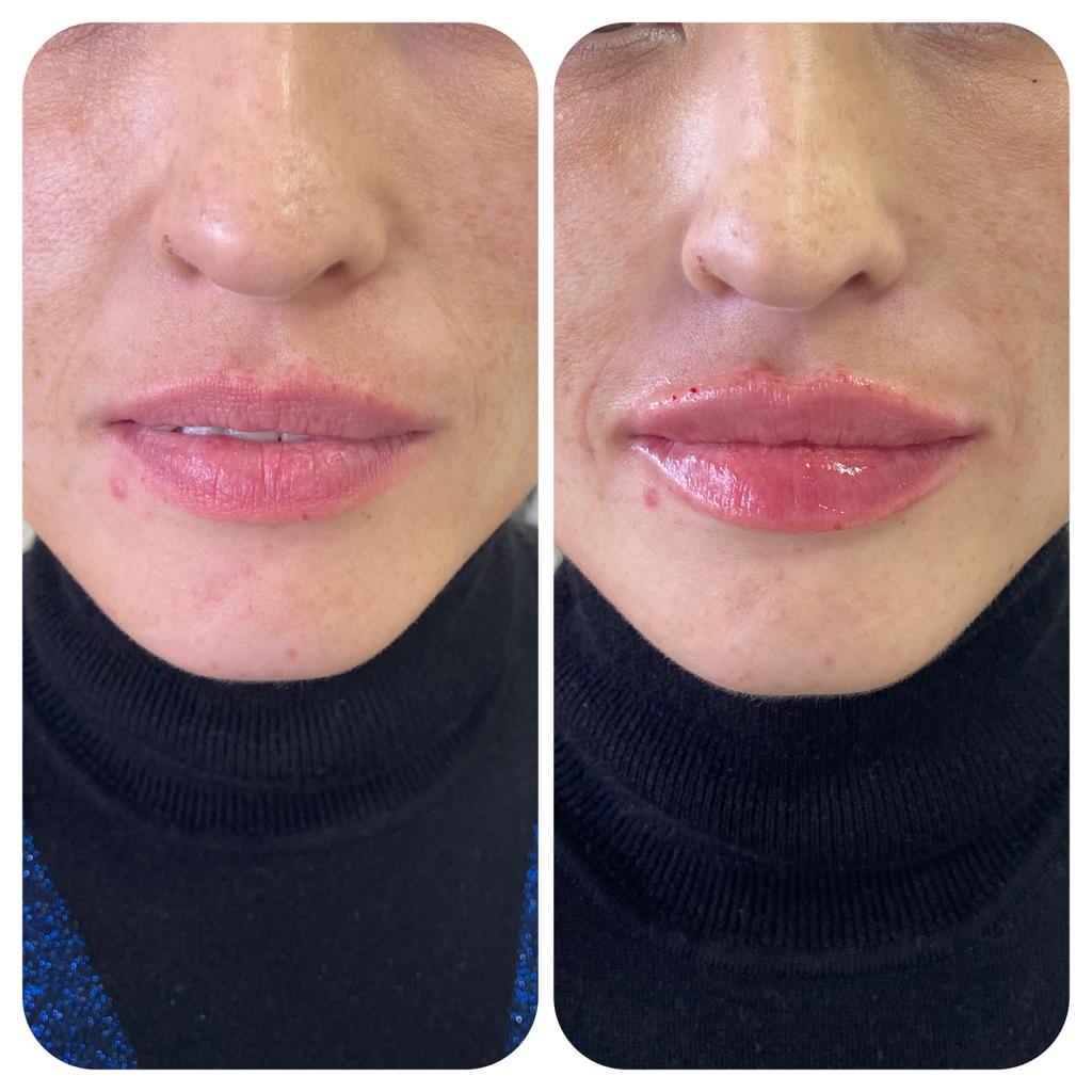 koreanmed.kz.injectable.fillers_2